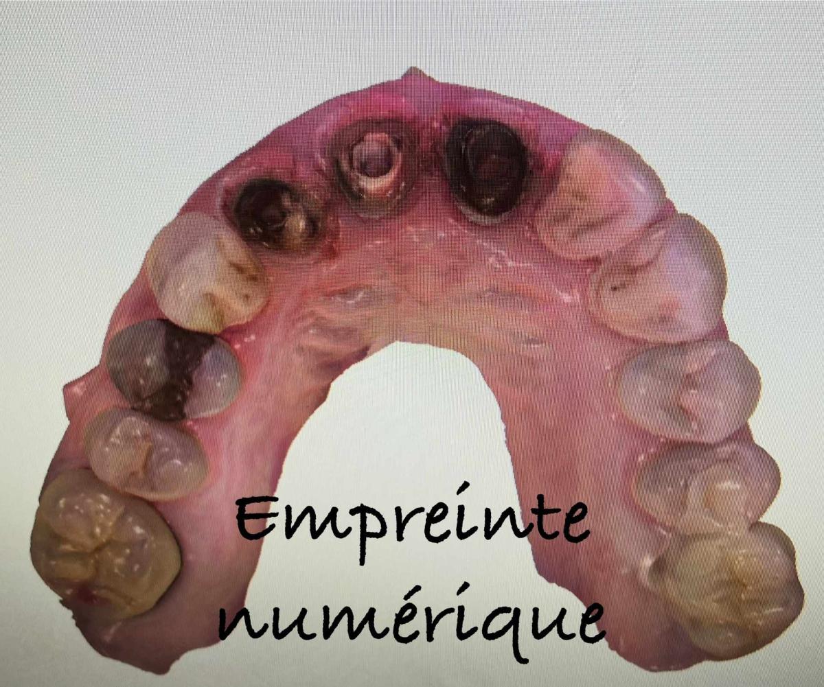 Fabrication de facettes dentaires